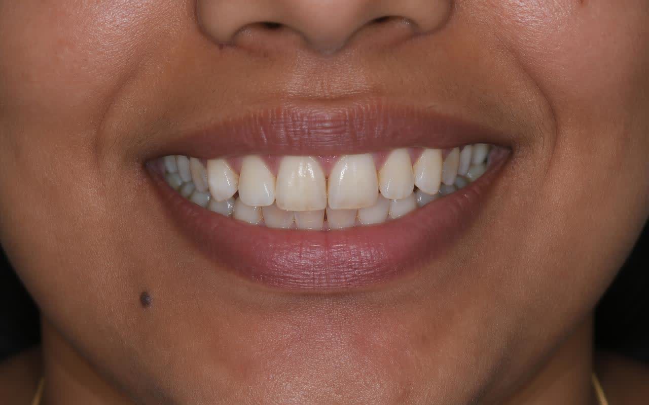 Smile Makeover before