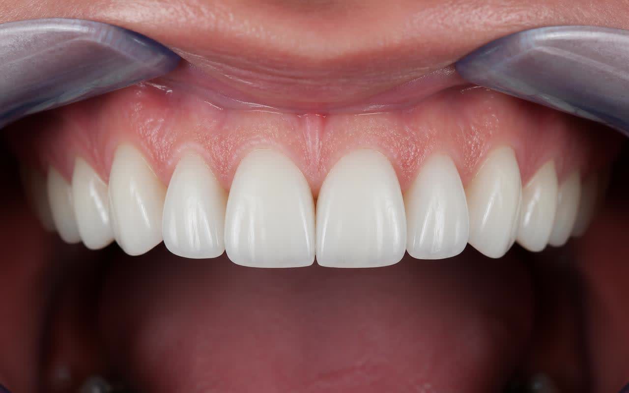 Cosmetic Veneers after